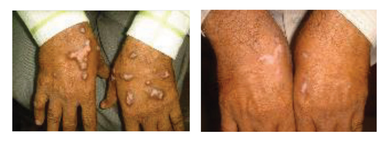 Psoriasis before and after 22 sessions. Photo courtesy Dr. Sakhiya